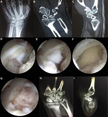 Arthroscopic Treatment of Intraosseous Ganglion Cysts of the Carpus